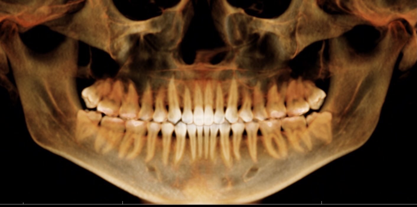 Wisdom teeth