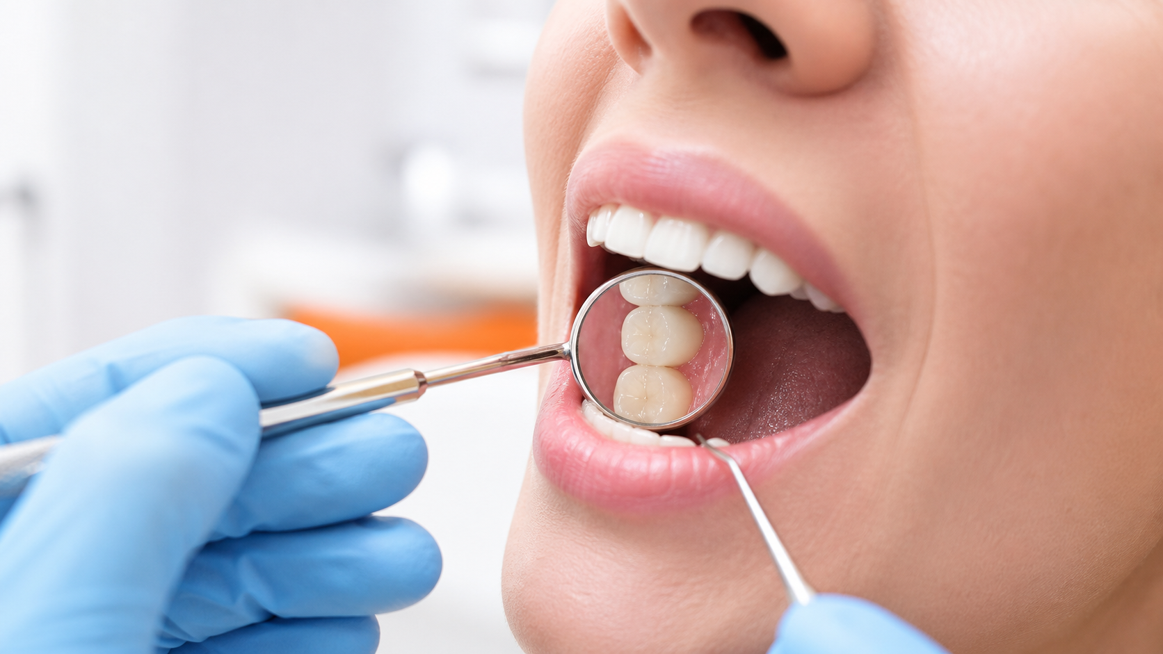 Resinas sin metal treatment