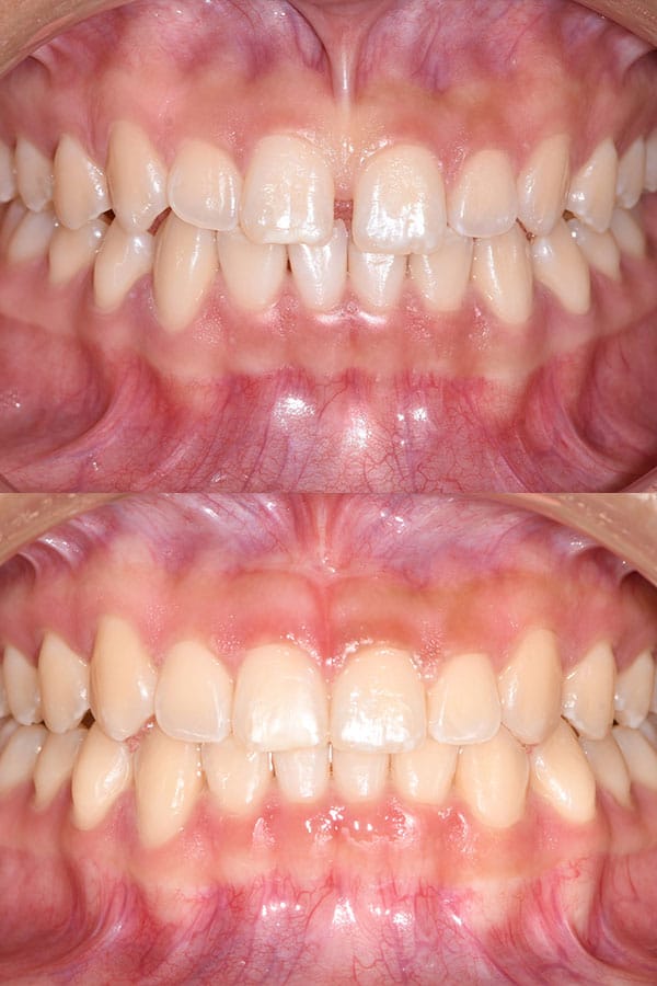 Frenectomy gallery result 1