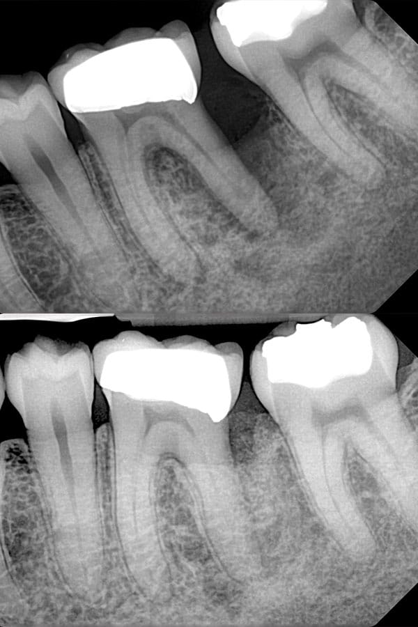 Guided Bone Regeneration gallery result 1