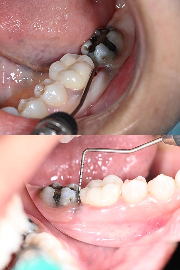 Guided Bone Regeneration gallery result 2