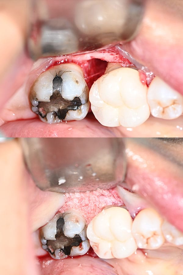 Guided Bone Regeneration gallery result 3