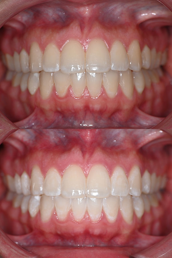 Blanqueamiento dental resultado 1